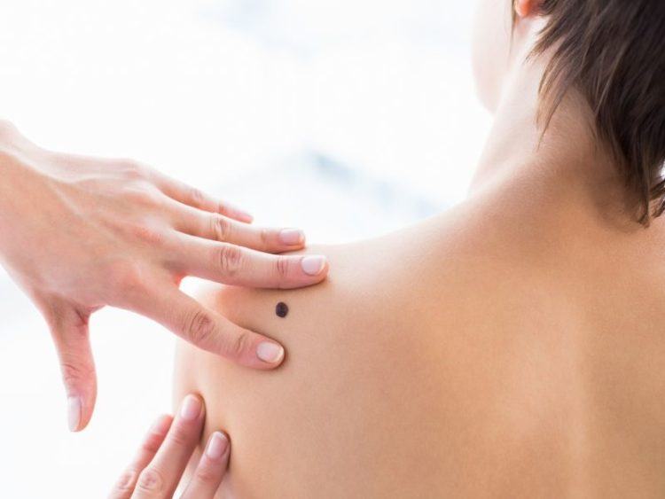 Cách tẩy nốt ruồi an toàn bạn có thể làm tại nhà 2