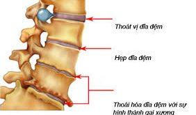 Hương nhu bài thuốc chữa bệnh vôi hóa cột sống 7