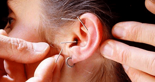 Đột phá y học cổ truyền chữa bệnh trên đôi vành tai bằng Nhĩ châm