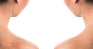5 loại thuốc trị sẹo hiệu quả bạn nên biết 4