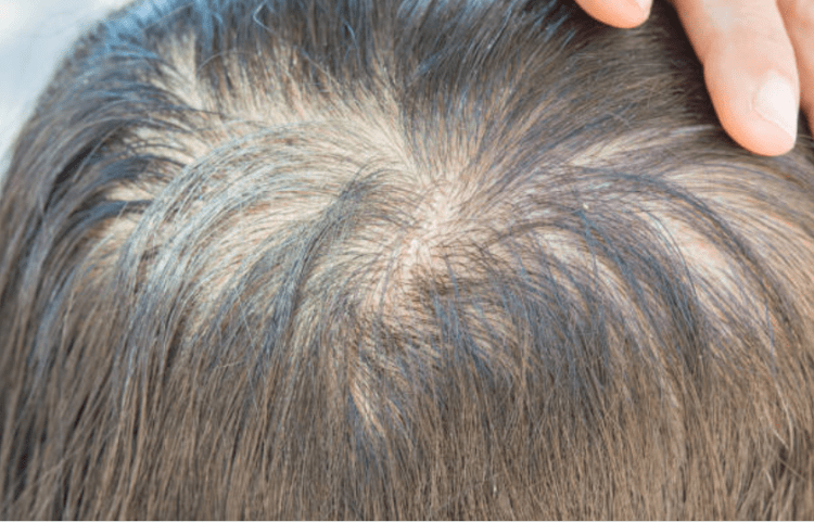 7 cảnh báo sức khỏe từ mái tóc bạn không thể xem thường! 3