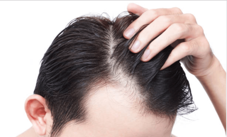 7 cảnh báo sức khỏe từ mái tóc bạn không thể xem thường! 5