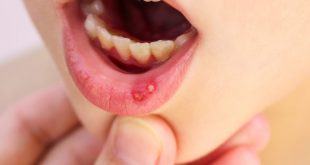 Những phương pháp điều trị nhiệt miệng hiệu quả 30