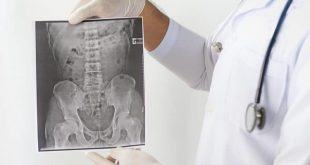 8 nguyên nhân khiến bệnh viêm cột sống dính khớp nặng hơn 12