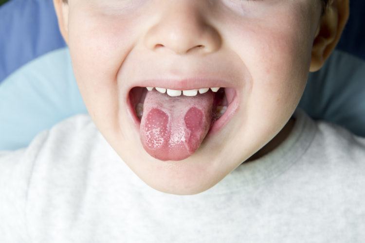 Bệnh viêm lưỡi bản đồ ở trẻ em: Hiểu rõ để giúp con mau khỏi 1