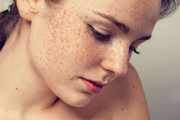 cách chữa nám da và tàn nhang