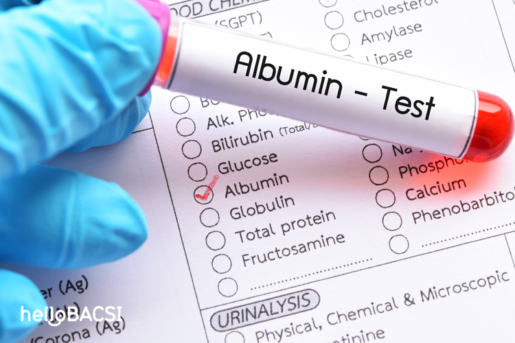 Xét nghiệm nồng độ albumin giúp phát hiện sớm tình trạng thận bị tổn thương