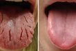 Top 7 Màu lưỡi bất thường báo hiệu cơ thể bạn mắc bệnh lý từ lâu