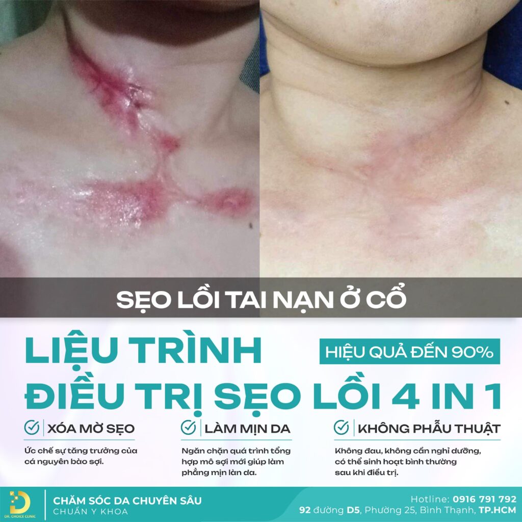 Review chuyên sâu về dịch vụ trị sẹo lồi tại Dr. Choice Clinic 1