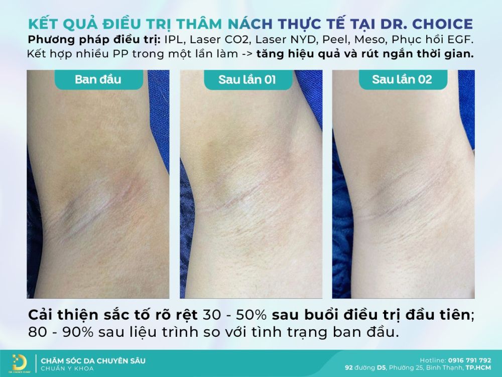 Báo giá trị thâm nách/bẹn tại Dr. Choice Clinic: có hiệu quả cao? 2